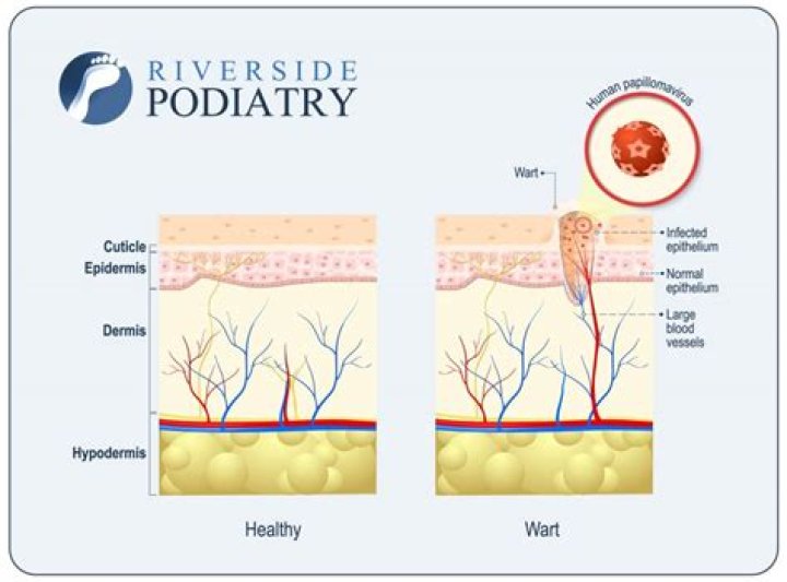 Do warts have a root?