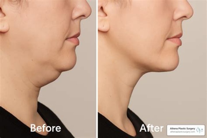 Does slapping under chin work?