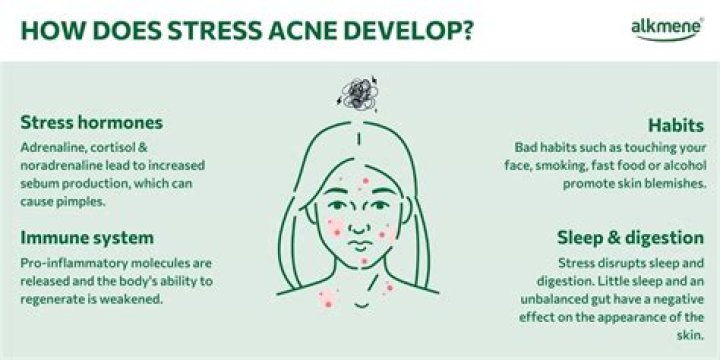 Does stress cause acne?