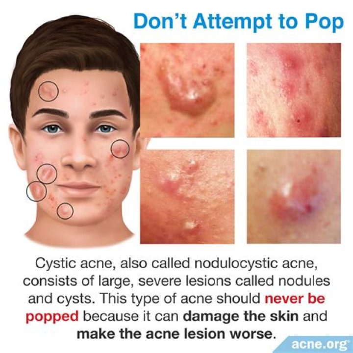 How does an acne look like?