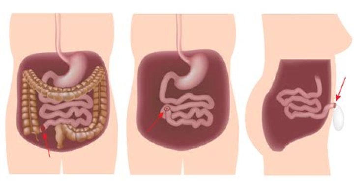 What is Panproctocolectomy?